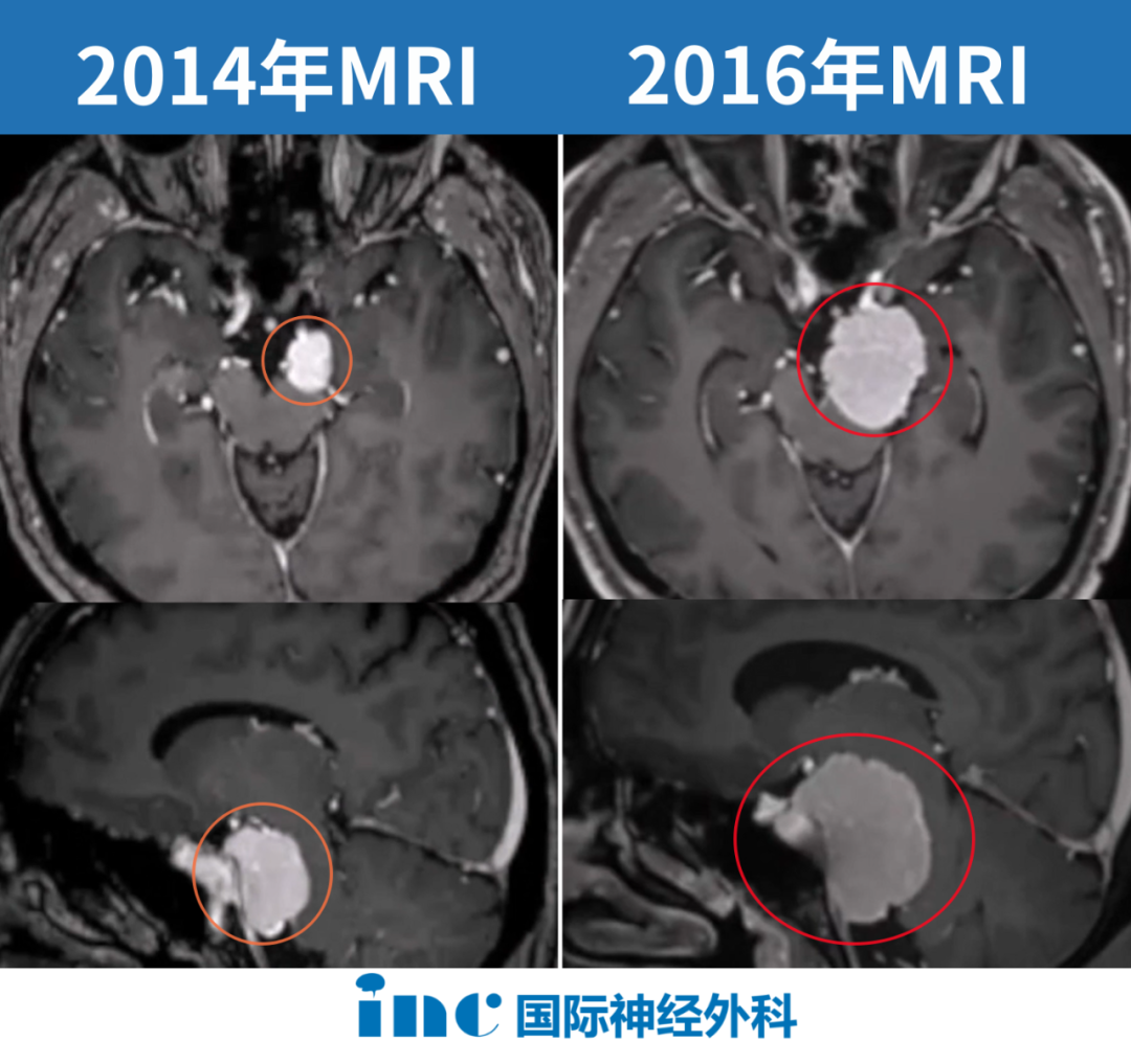 54岁男性、岩斜区脑膜瘤、吞咽困难，肿瘤显著增大、压迫脑干
