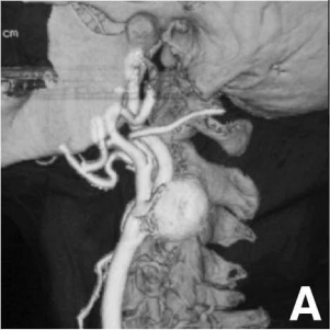 3D-CT血管造影显示位于左侧颈动脉分叉处的囊状动脉瘤