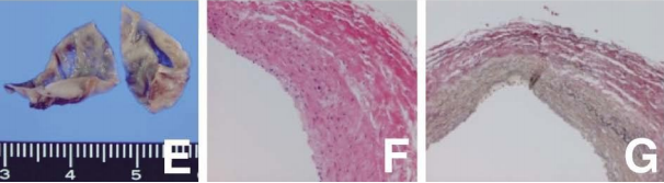 血管在不知不觉中“老化”、“变质”，最终形成了这个危险的膨出。