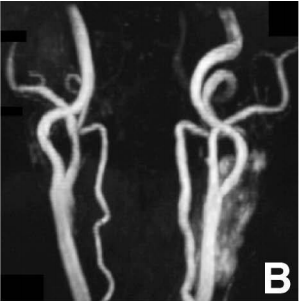术后磁共振血管造影显示动脉瘤消失，颈动脉通畅