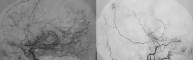 烟雾病血管造影影像