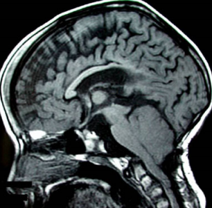 图2 矢状位 T1 加权脑像显示脑脊液循环的主要阻塞部位：导水管狭窄及第四脑室脑室层面的消失;桥前池囊性扩张;后颅窝结构拥挤;蛛网膜下腔层面枕骨大孔阻塞。
