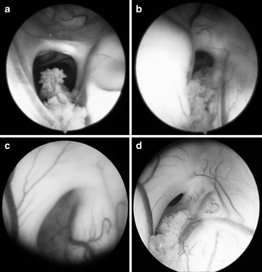 图3 内镜下右侧室间孔的不同形态，提示第三脑室穿刺难度逐渐增大。a 水平型 b 斜向型 c 垂直型 d 垂直且孔径缩小型