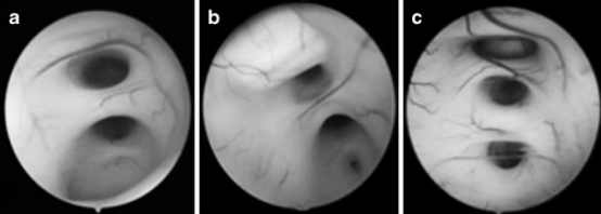 图4 内镜下第三脑室的不同表现，提示脑室解剖结构日益扭曲。a. 被下丘脑粘连分为两部分；b. 被下丘脑粘连分为两部分，视野下方可见导水管；c. 被两处下丘脑粘连分为三部分。