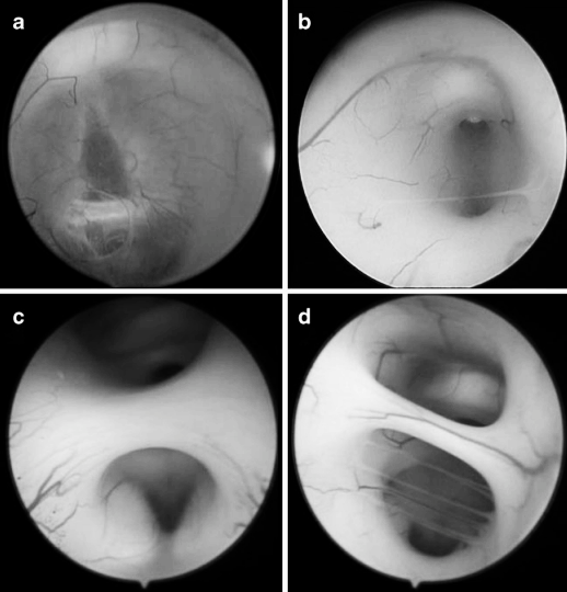 图5 内镜下第三脑室底的不同表现，导致实施 ETV（内镜第三脑室造瘘术）难度递增：a 呈水平状、半透明且菲薄，可清晰辨认漏斗隐窝；b 呈实质样，伴细薄下丘脑粘连；c 呈实质样，伴肥厚下丘脑粘连；d 呈实质样，伴肥厚下丘脑粘连及多条血管。