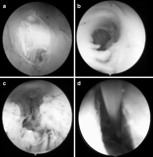 图6　第三脑室底造瘘后的内镜解剖所见。a　多层膜结构;b　实质样脑室底下方为通畅的脑池间隙;c　实质样脑室底下方存在多条蛛网膜粘连带;d　脑池深处仅见单一蛛网膜膜片，与实质样脑室底距离极远。