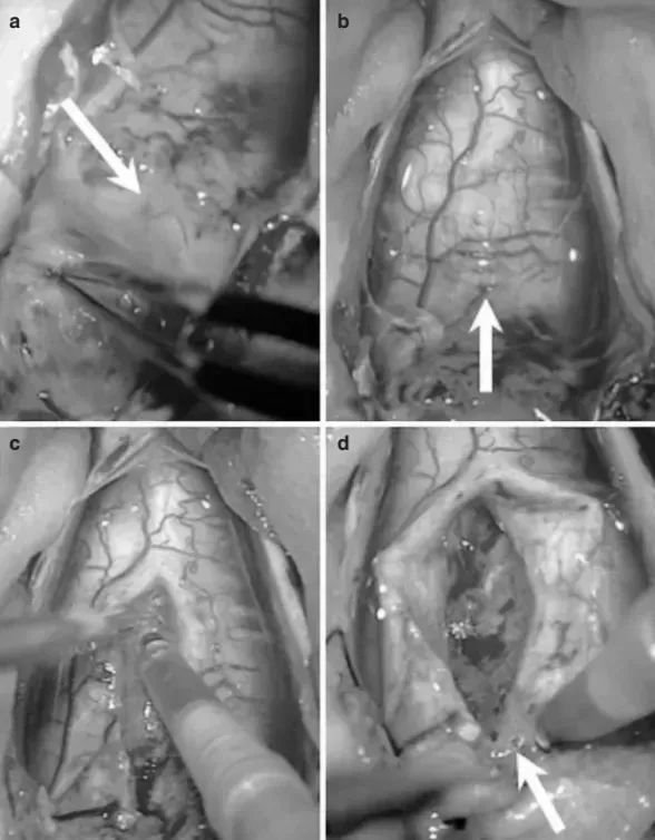 教授采用远外侧入路切除肿瘤，术中细致暴露肿瘤，控制出血、保护延髓正常组织