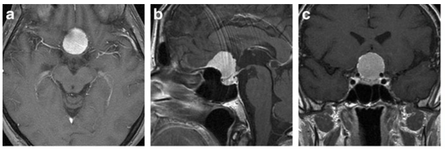 a–c  术前增强T1加权MRI，均显示鞍结节脑膜瘤