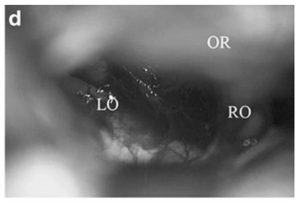 d  显微镜下经眉弓入路所见：可见左侧(LO)及右侧(RO)视神经;因眶顶(OR)遮挡，未能显露鞍膈。