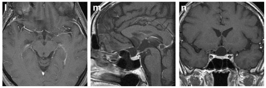 l–n  术后39个月增强T1加权MRI，均未见肿瘤残留或复发