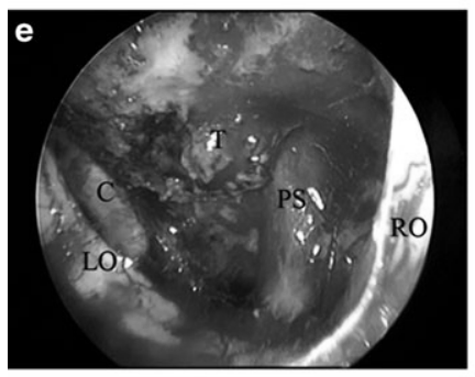 e  30°内镜下探查：可见左侧颈内动脉(c)、左视神经(LO)、右视神经(RO)、垂体柄(PS)及显微镜无法窥及的肿瘤残余(T)。