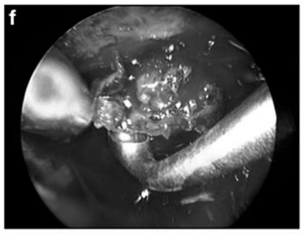 f  内镜辅助双手操作(bimanual)肿瘤切除。