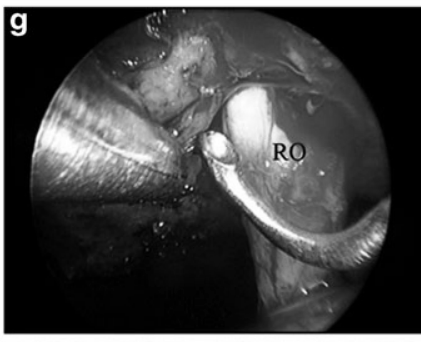 g  于右视神经(RO)内侧继续切除肿瘤。