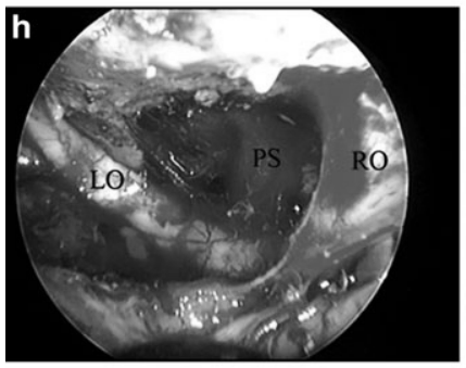 h  内镜下全切后所见：左视神经(LO)、右视神经(RO)及垂体柄(PS)均保持完整。