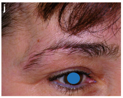 j  术后4个月外观照：美容效果满意。