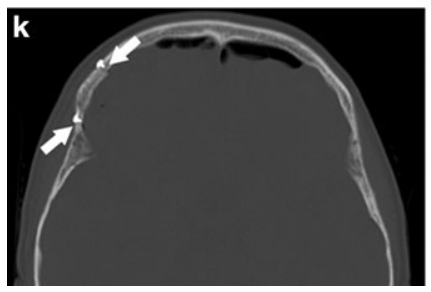 k  术后CT：示骨窗范围(箭头所示)