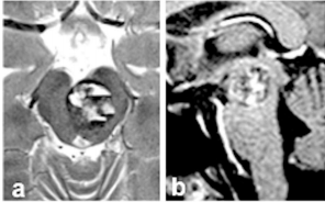 图a和b：术前轴向(a)和矢状(b)MRI