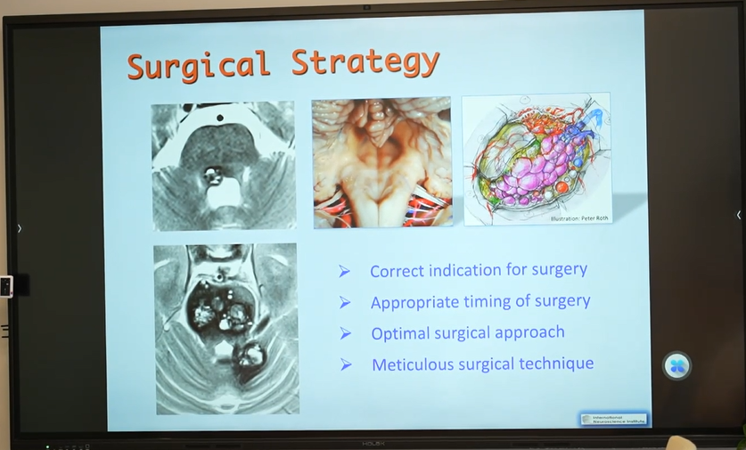 巴教授认为，要想脑干海绵状血管瘤手术取得理想效果，其中十分重要的四大要点包括：正确的手术指征、适当的手术时机、合适的外科手术入路、精细的手术技术。