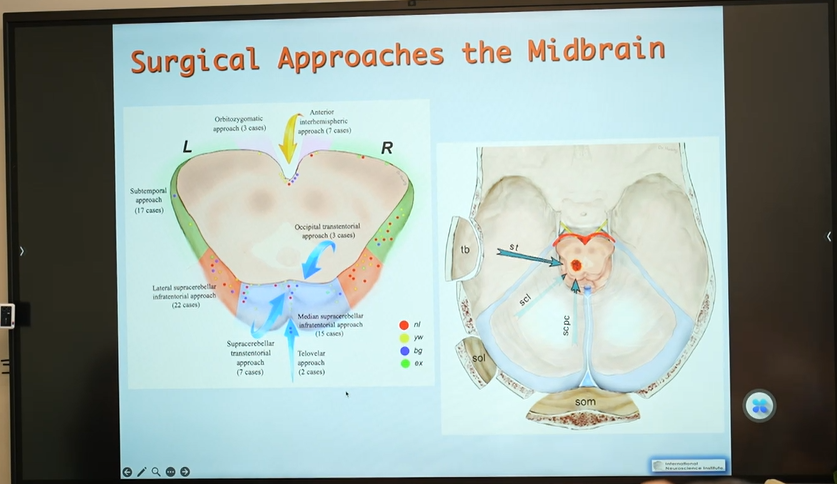 巴教授展示了在中脑中使用的各种手术入路以及所获得的中脑暴露区域，包括枕下外侧入路、颞下入路、经幕下小脑上、幕下小脑上外侧入路。其中，右侧颞下入路更常用于进入中脑海绵状血管瘤，以避免损伤显性颞叶。