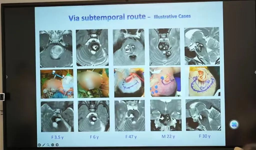 桥脑海绵状血管瘤案例
