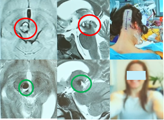 中脑海绵状血管瘤案例