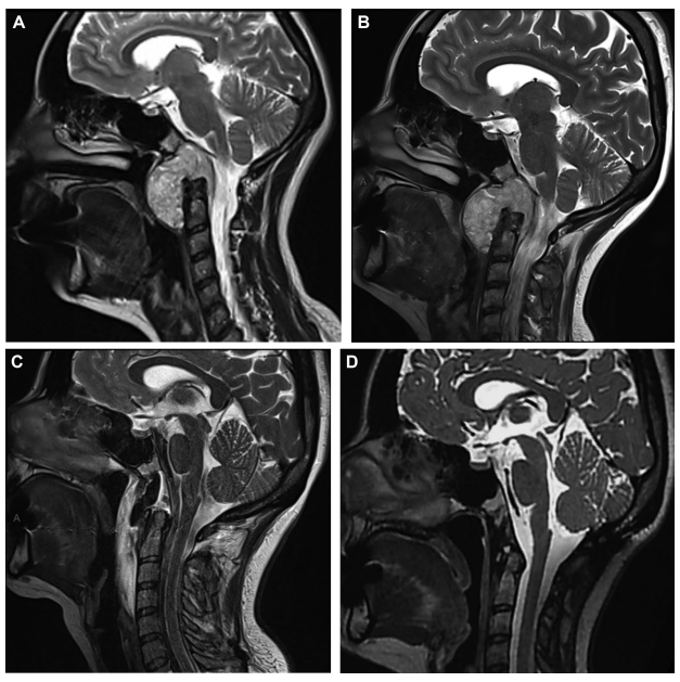 图示：MRI 显示一例颅颈交界区（CVJ）脊索瘤，其术前肿瘤生长速率（TGR）较低（3.53%/月）。