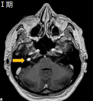 Ⅰ期：内听道期