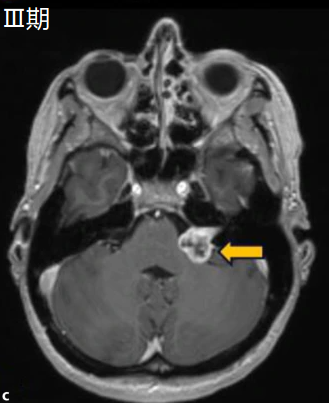 Ⅲ期：脑干受压期