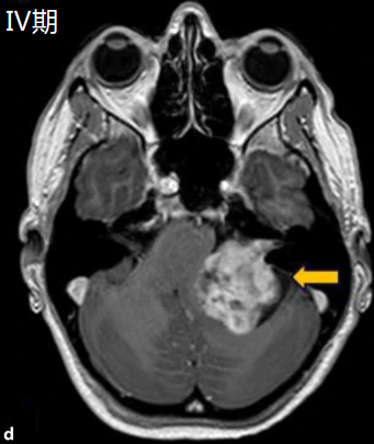 Ⅳ期：脑干及脑室受压期
