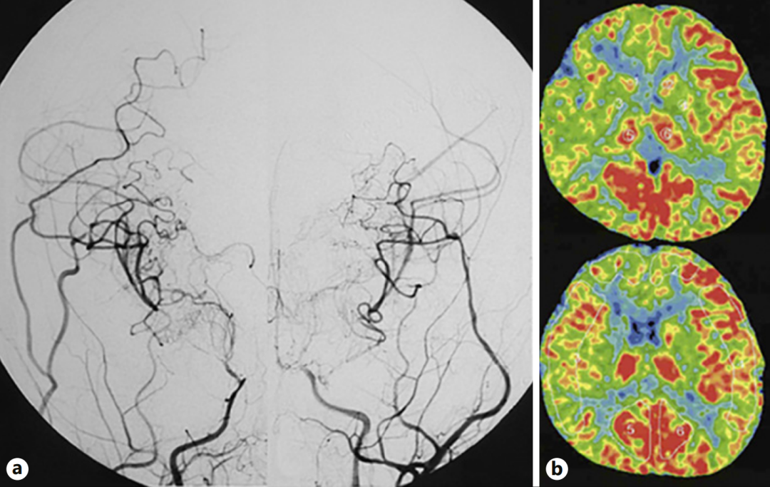 图a：第二次手术半年后，双侧颈内动脉血管造影显示侧支血管网络发育良好，基底烟雾血管消退。