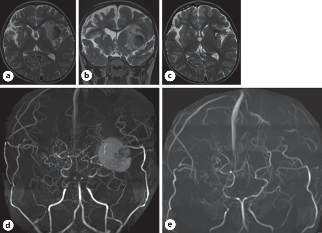 随访轴位(a)与冠状位(b)T2加权磁共振成像(MRI)图像。可见左侧岛叶病灶扩大至两倍以上，周围伴有水肿组织。  　　(c)术后T2加权MRI显示，原异常病灶已被手术疤痕组织取代。术前(d)与术后(e)磁共振血管造影(MRA)。术前MRA上的较大病灶在术后影像中已消失。