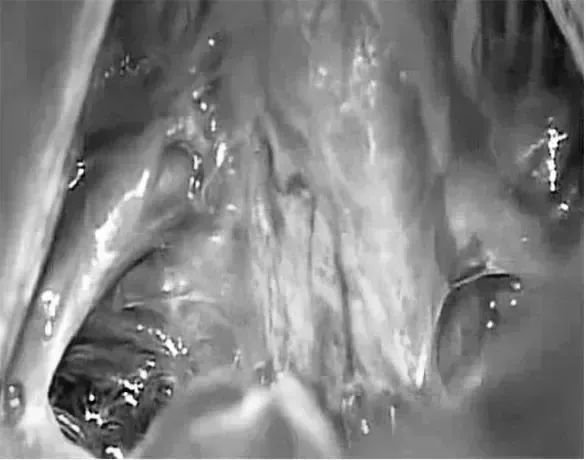 术中照片显示Galenic静脉引流通过小脑上蚓，小脑左侧旁入路暴露的路线