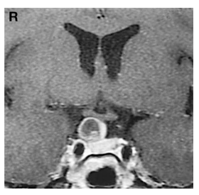图1：入院时磁共振成像：可见一囊性病灶与垂体柄紧贴，囊壁及内部实性部分呈轻度强化;蝶鞍内垂体形态正常，鞍隔呈低信号带位于肿瘤与垂体之间，二者之间未见连续性。