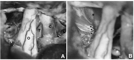 手术采用右侧额颞开颅。进入鞍上区后，见肿瘤位于右侧颈内动脉内侧、视神经下方(图 2A)。磨除前床突并切开视神经管后，将肿瘤与颈内动脉分离。穿刺囊腔抽出透亮、似脑脊液样液体。肿瘤实性部分为轴外病变，呈红褐色，质地富有弹性。肿瘤位于蛛网膜下腔，与垂体柄轻度粘连，但易于分离。肿瘤全切除后，垂体柄及鞍隔保持完整(图 2B)