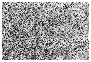 图3：组织切片显微照片(HE染色，×200)。典型窦隙状(sinusoidal)垂体腺瘤结构清晰可见。