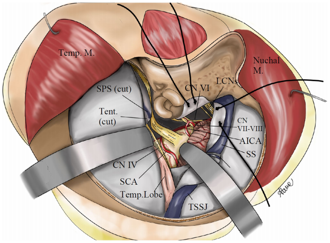 福教授决定采用内镜经鼻入路+mini经岩骨入路，而后者正是福教授及团队为减少损伤而改良后的版本。