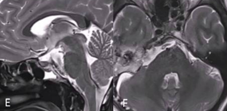 然而，对于狡猾的脊索瘤而言，全切相当于为整体的治疗开了一个好头，后续仍然要进行辅助治疗，才能最大程度延缓复发。