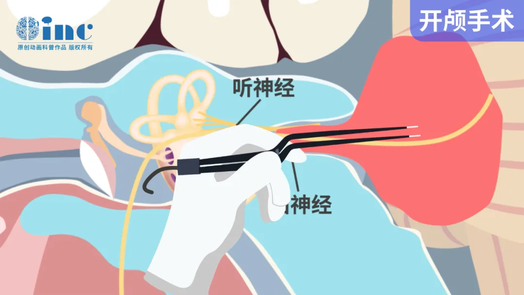 6年4次耳聋没重视，一查竟是脑瘤！