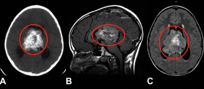 室管膜瘤5年生存率可达84%！综合治疗方案让他6年无复发