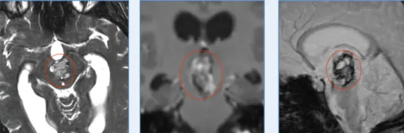 脑干海绵状血管瘤