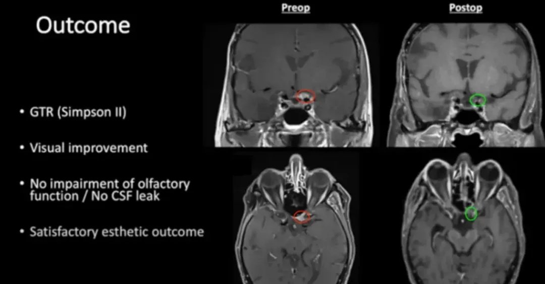 术前及术后磁共振成像。术前preop（A）和术后Postop（C）显示肿瘤完全切除。