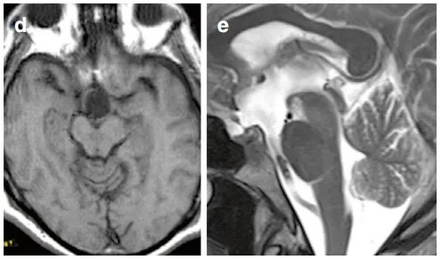 术后MRI证实肿瘤已肉眼全切