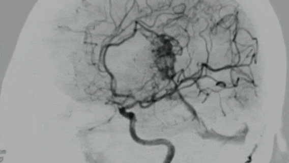 脑动静脉畸形伴脑出血