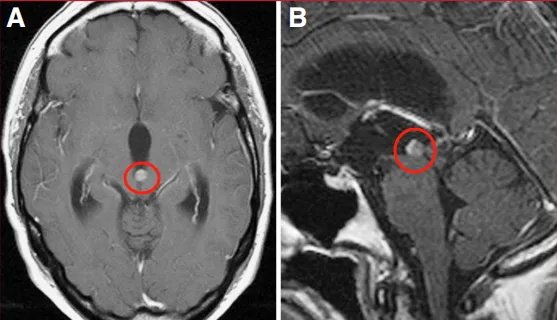 磁共振成像（MRI）显示一小型、明显强化的占位性病变阻塞中脑导水管，导致三脑室性脑积水（图1）。