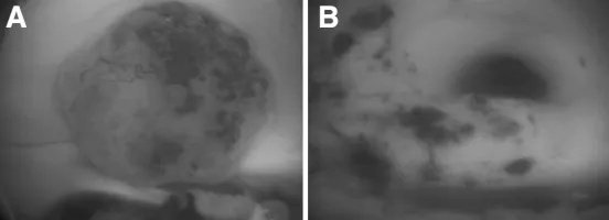 经右侧室间孔（Monro孔）行内镜下手术（图A）。术中实现病变全切除(图B)。