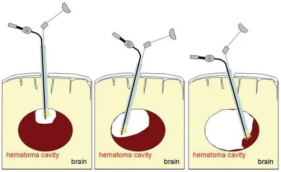神经内镜清除颅内血肿示意图