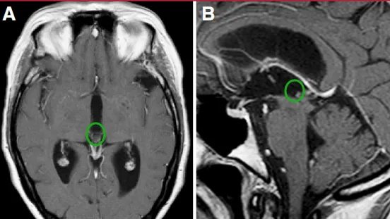 术后MRI复查示病灶无残留，脑积水已完全缓解。