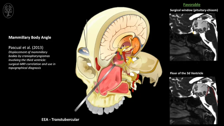 第一阶段：内镜经鼻手术对视交叉和神经进行减压