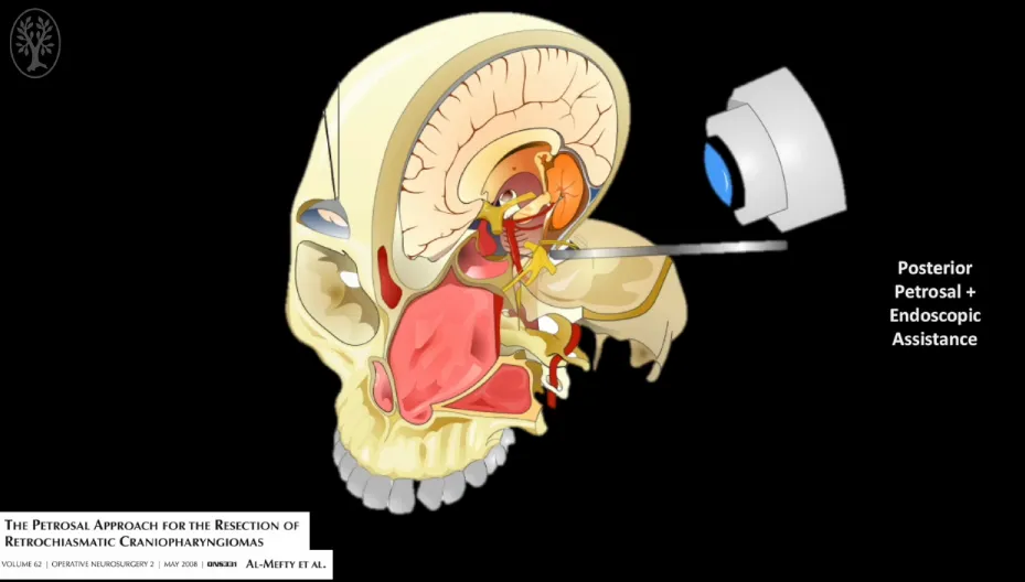 第二阶段：后岩骨入路开颅全切肿瘤