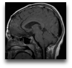 治疗颅咽管瘤影像